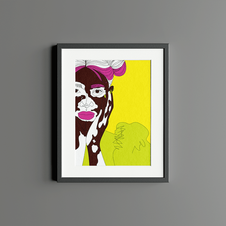 VAGPWR Art Print Print - Vitiligo